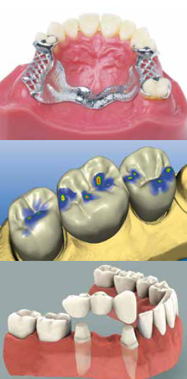 Dental Lab in Brampton - dentures