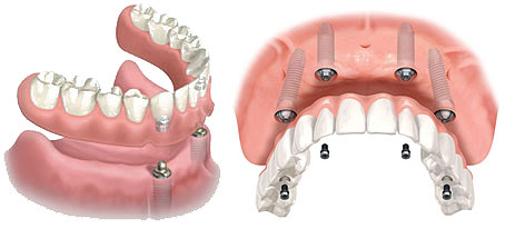 dds lab brampton - implant over dentures